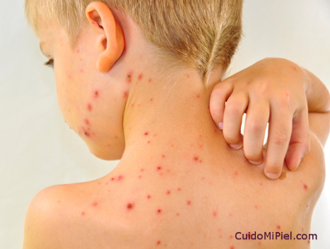Enfermedades Infecciosas Varicela